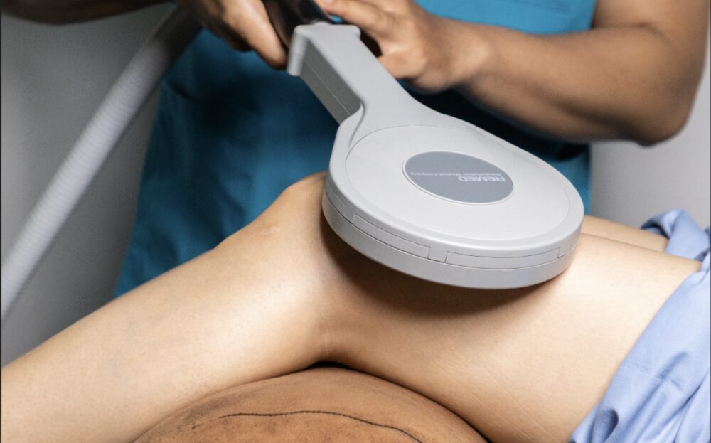 Peripheral Magnetic Stimulation